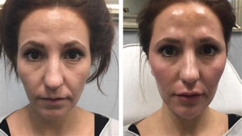 Sculptra® Overview: Cost, Recovery, Before & After .